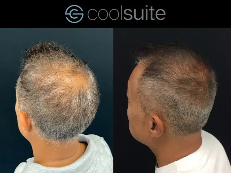 Hair Restoration Clinic — Richmond, BC at Templus Life clinic in Richmond BC